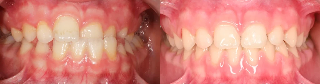 Cas de correction d'une occlusion inversée